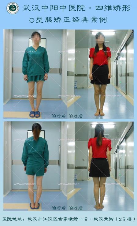 怎樣使X型腿變直?武漢中陽中醫(yī)醫(yī)院“四維矯形”技術無痕矯正