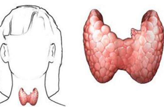 什么是單純性甲狀腺腫?患單純性甲狀腺腫的原因