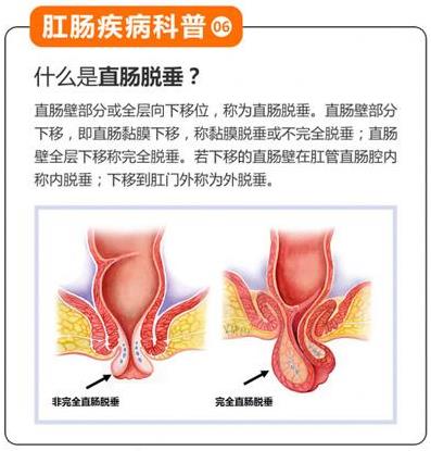 昆明東大肛腸醫院提醒:肛門脫出的肉球除了痔瘡,還要當心是脫肛