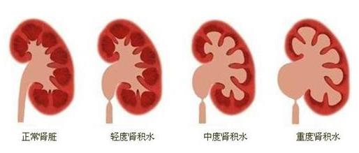 云南結石病醫院腎結石患者:腎結石癥狀腰疼就像一把刀子來回絞動