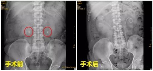 云南結石病醫院腎結石患者:腎結石癥狀腰疼就像一把刀子來回絞動