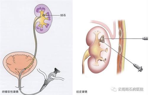 云南結石病醫院腎結石患者:腎結石癥狀腰疼就像一把刀子來回絞動