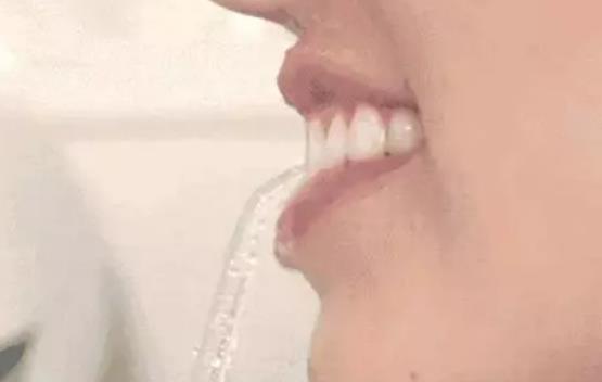 牙縫變大可以補嗎?牙縫變大的原因有哪些?