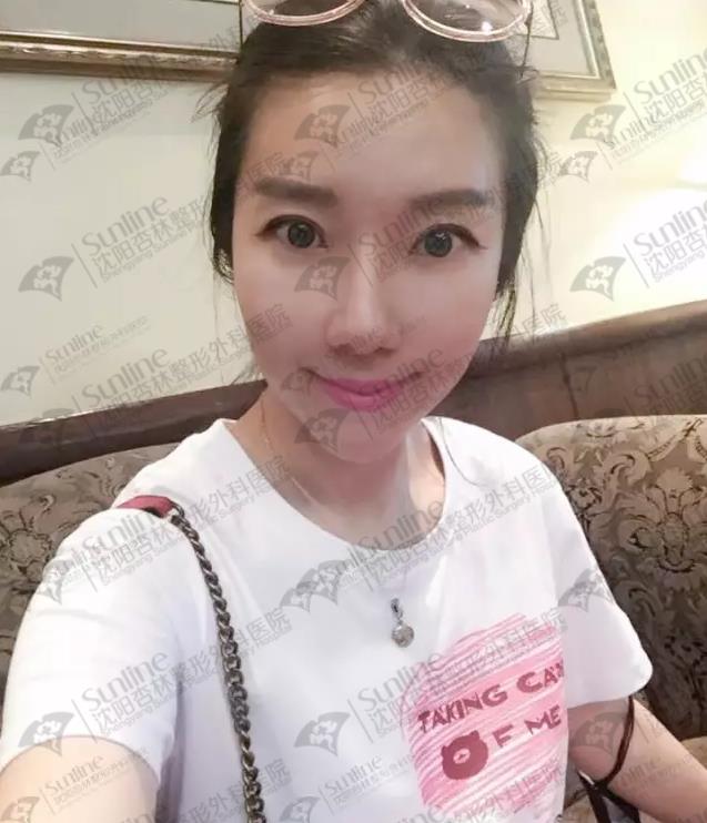 沈陽玻尿酸案例,有它才是女神的標配,重回十八歲!