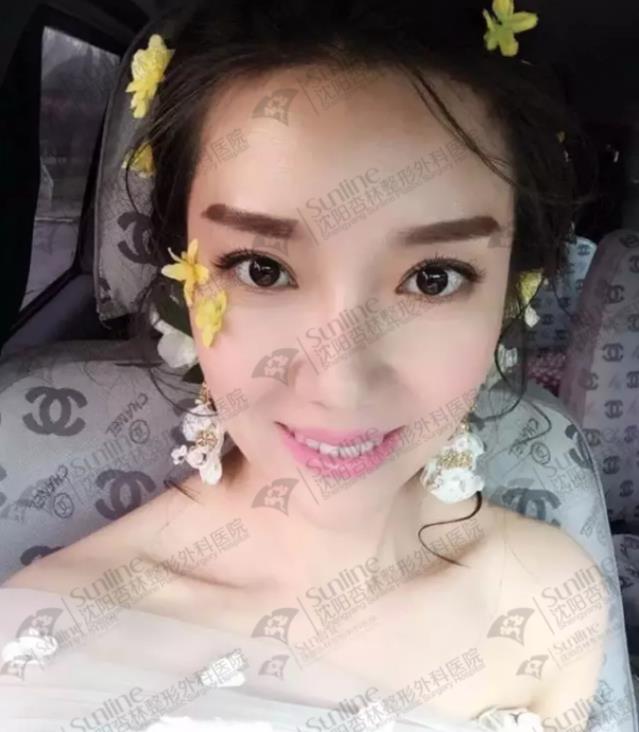 沈陽玻尿酸案例,有它才是女神的標配,重回十八歲!