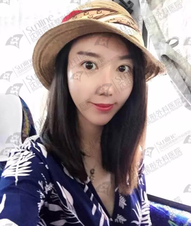沈陽玻尿酸案例,有它才是女神的標配,重回十八歲!