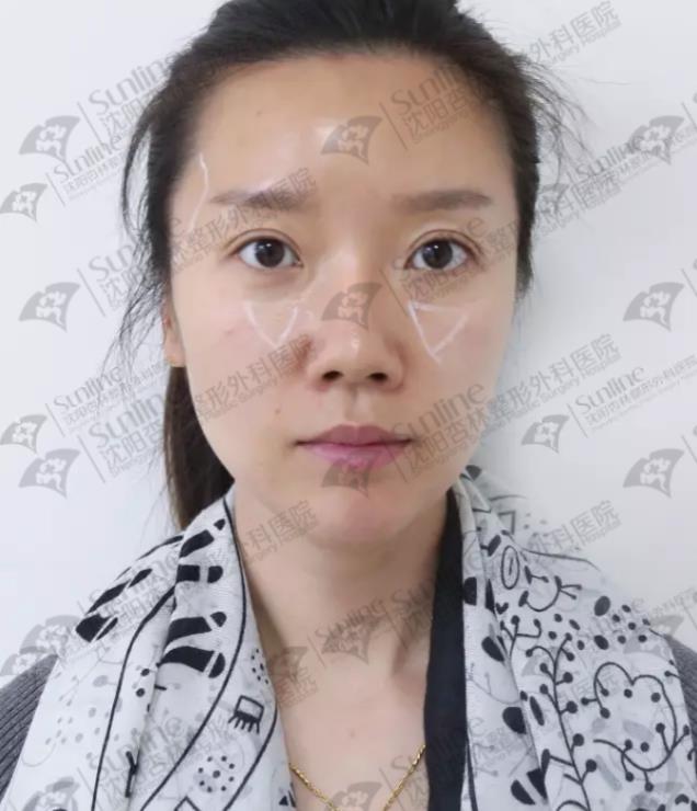 沈陽玻尿酸案例,有它才是女神的標配,重回十八歲!