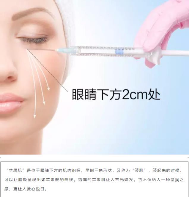 沈陽玻尿酸案例,有它才是女神的標配,重回十八歲!
