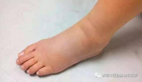 濟南中醫靜脈曲張醫院口碑好嗎 專業醫療成就健康