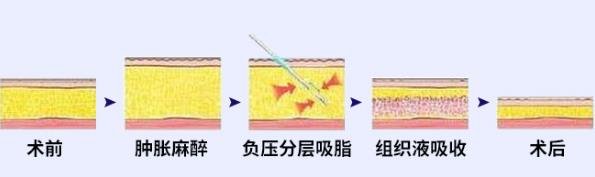 北京煤醫李艷博士微塑全層纖巧吸脂 ,不止于瘦,更重于塑