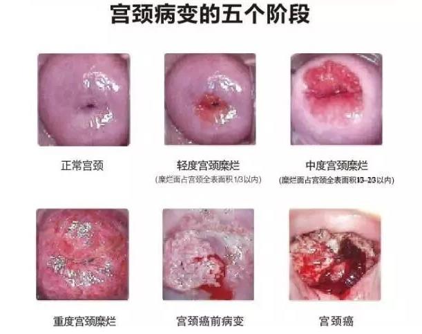 洛蔓蒂克:從陰道炎到宮頸癌的全過程!趕緊收藏