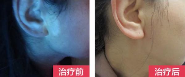 煙臺治白巔力推煙臺半島好,面部白斑別苦惱