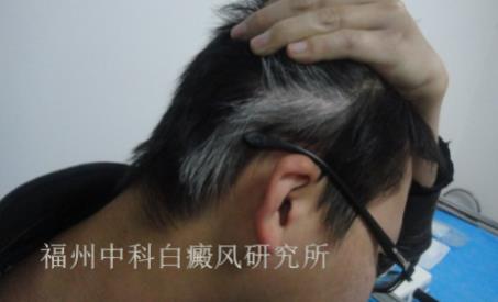 「分享」患白癜風三年的福州患者的經驗分享_福州中科醫院