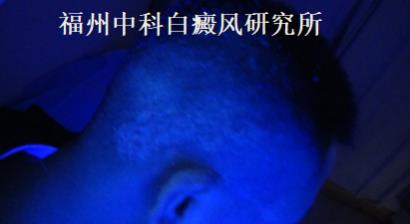 「分享」患白癜風三年的福州患者的經驗分享_福州中科醫院