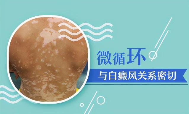 杭州華研白癜風醫(yī)院好嗎?白癜風罪魁禍首是它!早發(fā)現(xiàn)早改善,祛白更快!