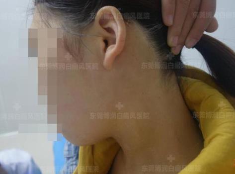 東莞博潤醫院白癜風如何預約?為何白癜風出現后要及時進行治療