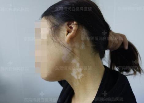 東莞博潤醫院白癜風如何預約?為何白癜風出現后要及時進行治療