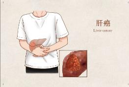 貴州盛京中醫(yī)肝病醫(yī)院看肝病技術(shù)怎么樣 為患者的健康負(fù)責(zé)