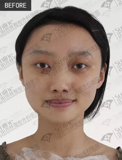 沈陽杏林整形醫院玻尿酸隆鼻如何