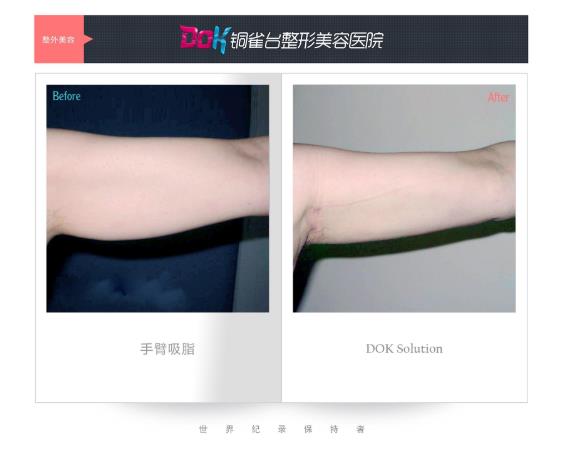 昆明銅雀臺(tái)整形醫(yī)院左萬(wàn)昌主任吸脂如何 任何肥胖部位都可以吸脂?