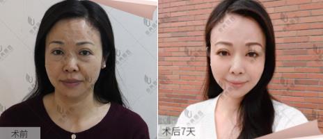 京典麗園不開刀去眼袋權威嗎?不開刀真的好嗎?