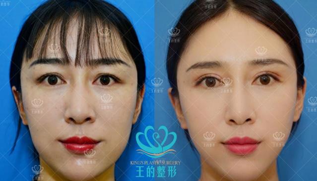 雙眼皮修復有多難?云南王海木院長告訴你