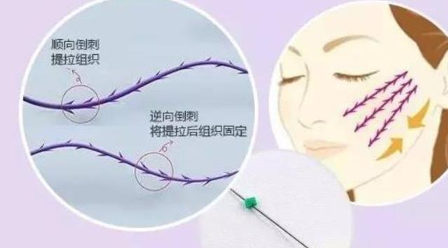 北京瑞鑫創美醫療美容醫院做線雕好嗎?線雕這么多種類怎么選?