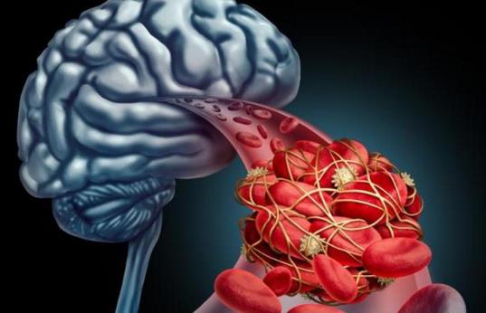 腦栓塞和腦血栓有什么區別?腦栓塞的癥狀是什么