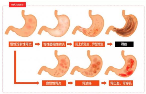 呼市東大肛腸醫院 很多人不聽勸,沒多久查出了胃癌……很多悲劇,幾乎每天上演!