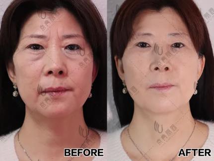 京典麗園不開刀去眼袋 搞清區別對癥下藥告別眼袋困擾!