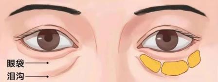 京典麗園不開刀去眼袋 搞清區別對癥下藥告別眼袋困擾!