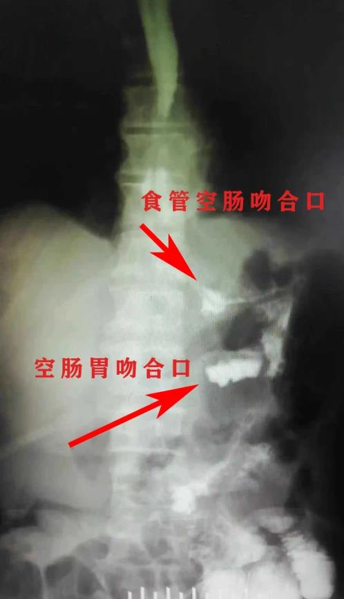 見招拆招 | 我院成功實施一例食管胃結合部癌切除雙通道吻合術