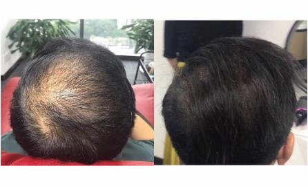 日輕絲增發技術成熟嗎 效果怎么樣