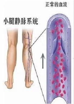 泉州成功醫院看下肢靜脈曲張好不好 療效來自專業的技術