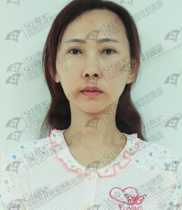 面部填充案例,沈陽(yáng)自體脂肪填充案例
