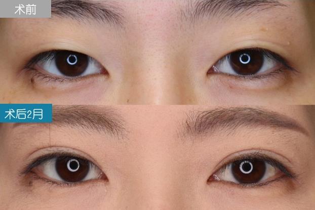 圣心美容丁奕如醫生解析:想要get自然的日式雙眼皮,需要注意哪幾點?
