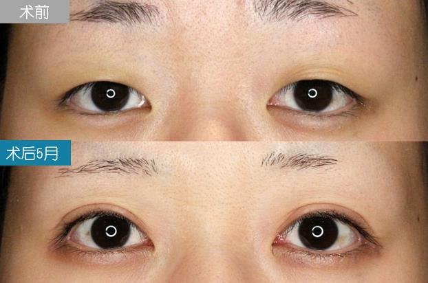圣心美容丁奕如醫生解析:想要get自然的日式雙眼皮,需要注意哪幾點?