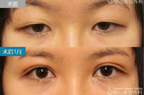 圣心美容丁奕如醫生解析:想要get自然的日式雙眼皮,需要注意哪幾點?