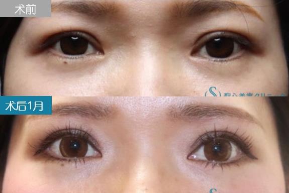 圣心美容丁奕如醫生解析:想要get自然的日式雙眼皮,需要注意哪幾點?