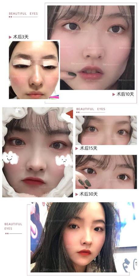 云南銅雀臺左萬昌主任喜善眼口碑如何 讓你宛如天生般自然