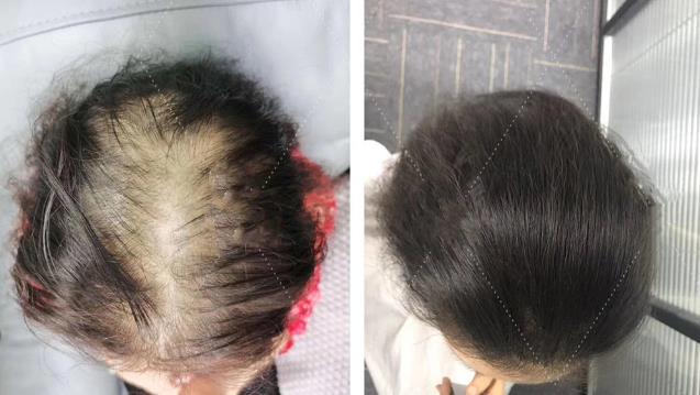 面對頭發(fā)稀疏怎么辦?日輕絲輕增發(fā)技術來幫忙