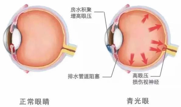 青光眼的高發人群是哪些人 合肥愛爾眼科醫院專家解答