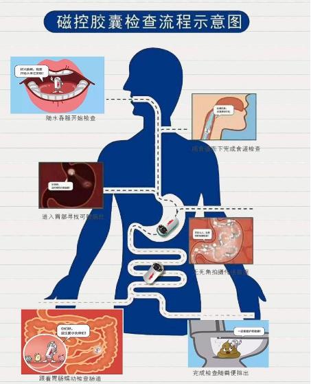 南寧東大醫院這顆電子膠囊胃鏡作用太奇妙,再也不用怕胃鏡檢查~