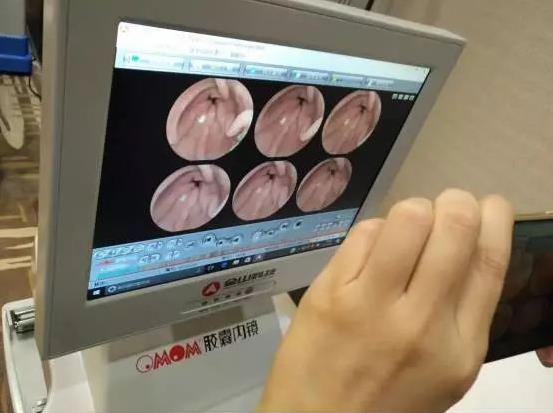 南寧東大醫院這顆電子膠囊胃鏡作用太奇妙,再也不用怕胃鏡檢查~