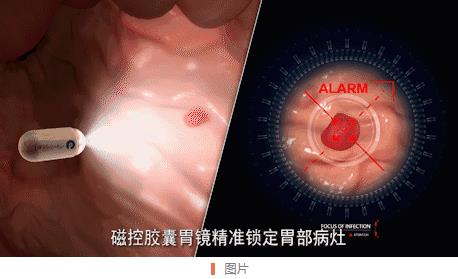 南寧東大醫院這顆電子膠囊胃鏡作用太奇妙,再也不用怕胃鏡檢查~