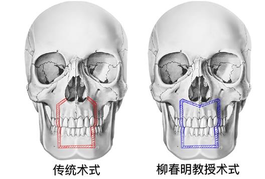 聯合麗格柳春明教授:凸嘴的人為什么通常鼻基底也凹陷?
