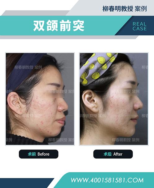 聯合麗格柳春明教授:凸嘴的人為什么通常鼻基底也凹陷?