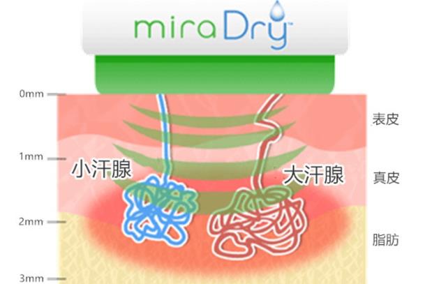 圣心美容高須淳司醫生解析:MiraDry清新微波治療腋臭多汗的原理和效果