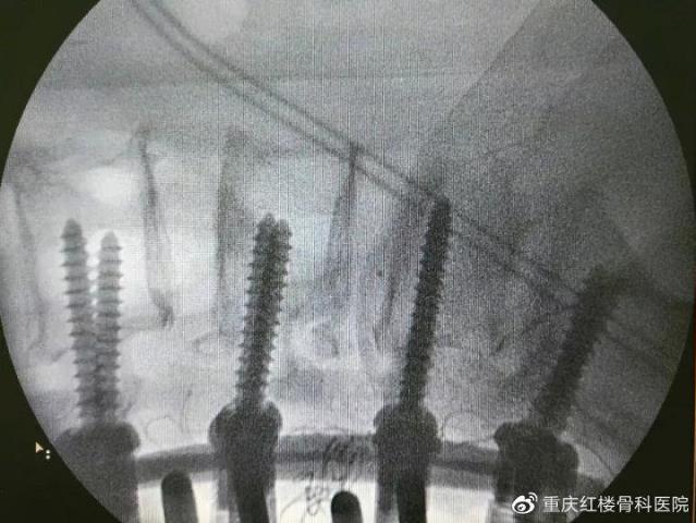 重慶知名的骨科醫院?重慶紅樓醫院微創術為腰椎滑脫患者消除病痛!