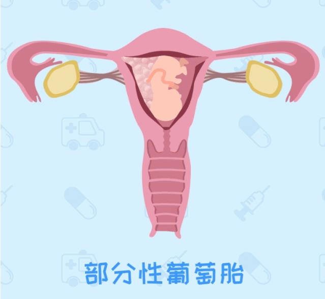 呼和浩特五洲醫院看病專業嗎HCG升高一定是懷孕嗎不可能還有詐